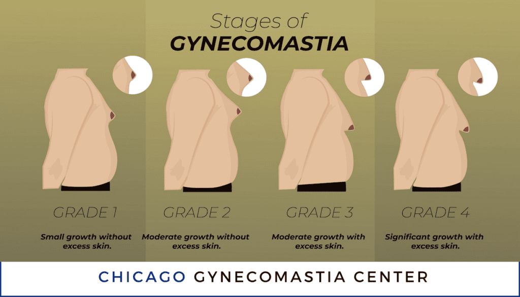 Stages and Grades of Gynecomastia Chicago