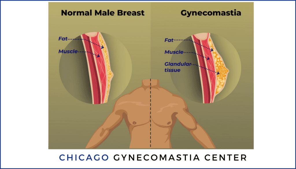 What is Gynecomastia Chicago